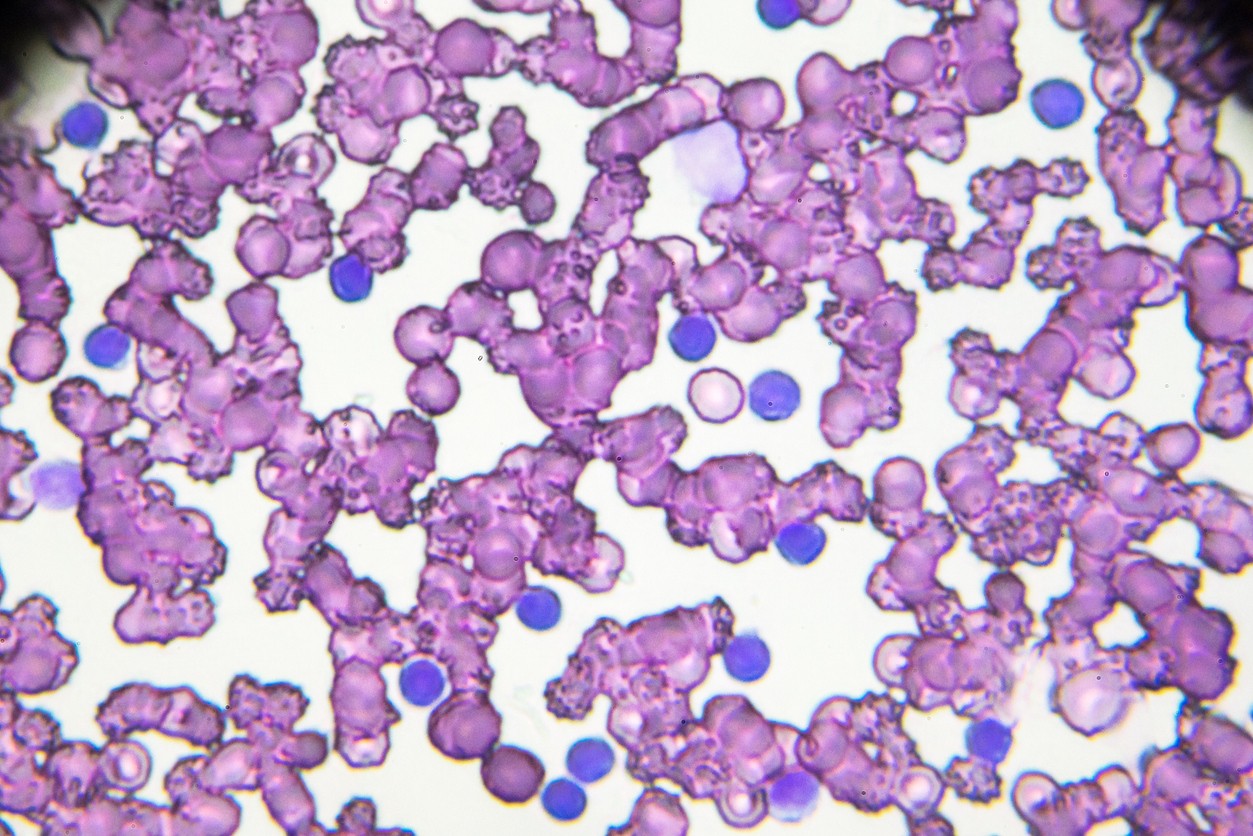 Chronic lymphocytic leukemia cells stained purple viewed under a microscope